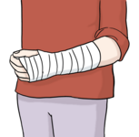 Person mit einem verbundenen Arm